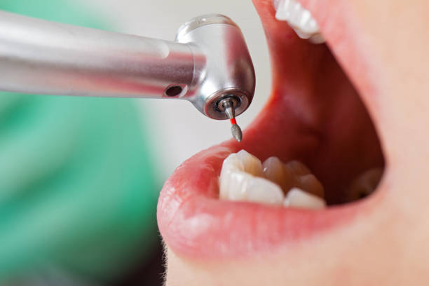 Best Cosmetic Emergency Dentistry in Notre Dame, IN